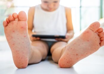 Brotes de mano-pie-boca y caso de dengue en Piedras Negras.