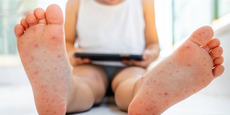 Brotes de mano-pie-boca y caso de dengue en Piedras Negras.